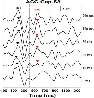 Acoustic Change Complex for a child with ANSD who is an excellent hearing aid user