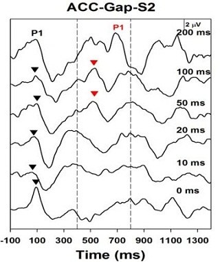 Acoustic Change Complex for a child with ANSD who is a moderately successful hearing aid user