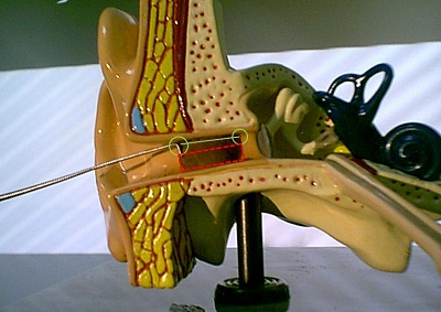 Complete cerumen impaction with the Day Hook positioned on the superior aspect of the accumulation
