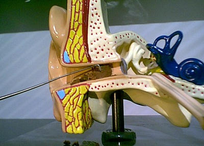 Using a Day Hook to work through the superior portion of the accumulation