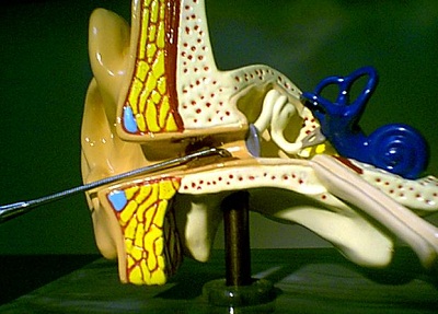 Buck curette placed at the back of the cerumen accumulation through the superior aspect of the ear canal