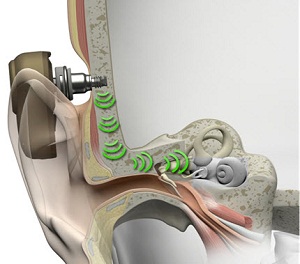 Pathway of direct bone conduction