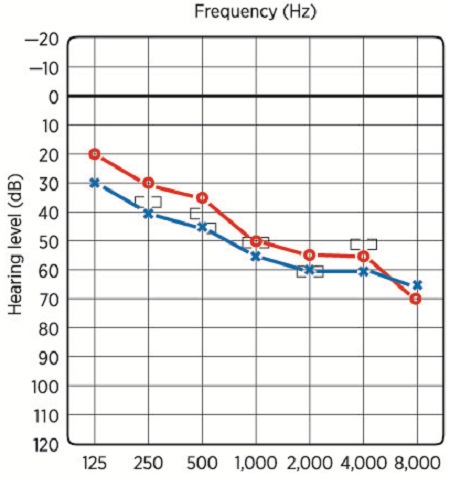 Audiogram for Case 2