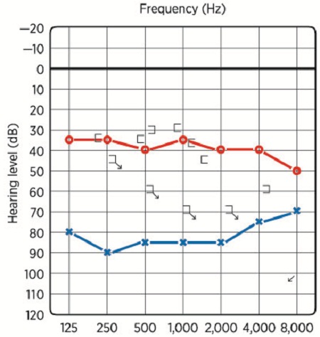 Audiogram for Case 1
