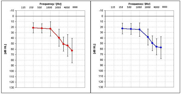 Average hearing loss and the range of losses for right and left ears for 20 subjects