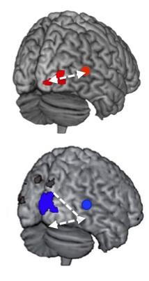 right occipito-temporal coupling during deafness and right occipito-tempora uncoupling after deafness