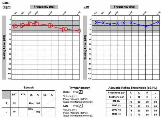 Audiometrical data of a patient with a unilateral acoustic neuroma on the right side