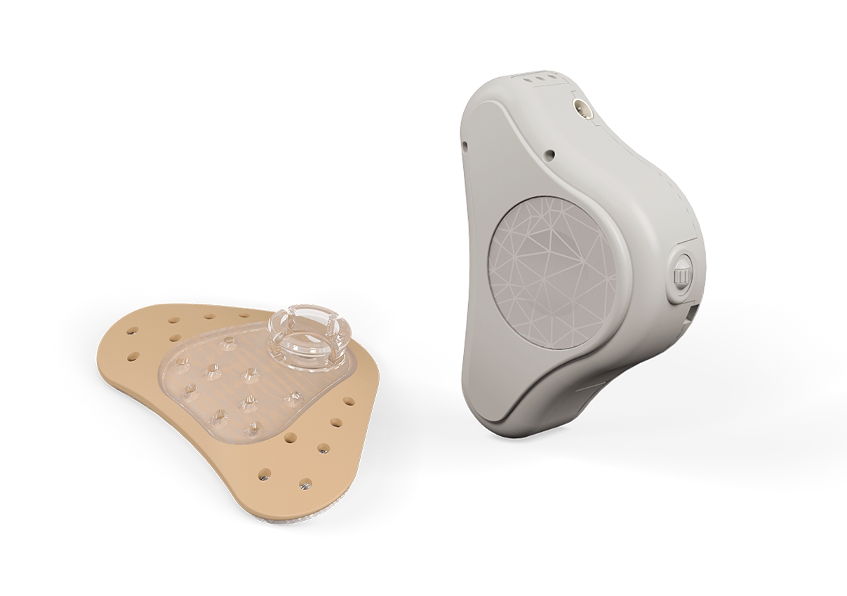 Cochlear implants