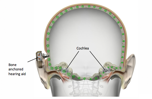 With a bone anchored hearing solution, sounds are converted to vibrations that stimulate the bones of the skull, and directed to both cochlea