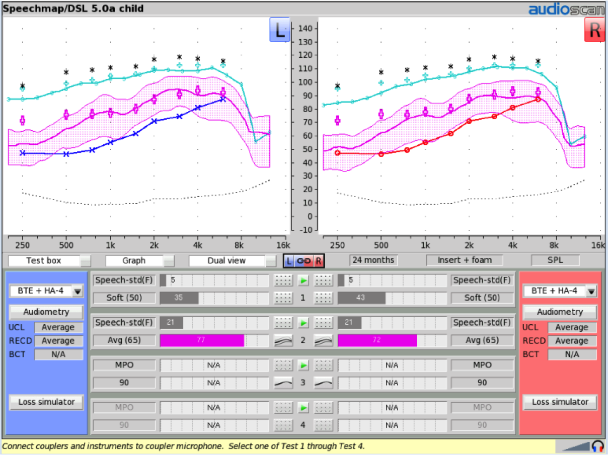 Audibility-based hearing aid fitting using DSL 5.0a for a 24-month-old child