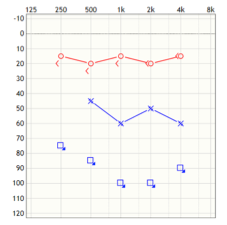 Audiometric profile Patient 1