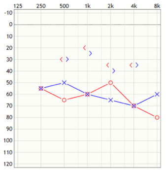 Audiometric profile Patient 2