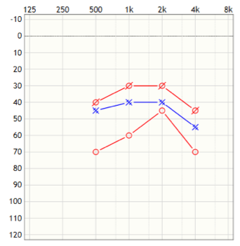 Aided sound field thresholds Patient 2
