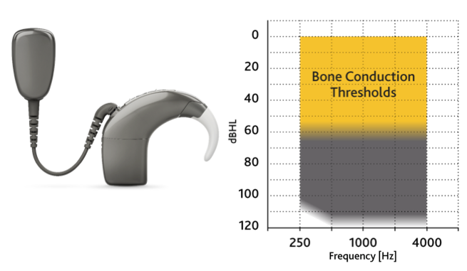 Baha 5 SuperPower Sound Processor and fitting range