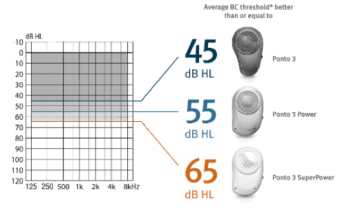Ponto 3 sound processors and fitting ranges