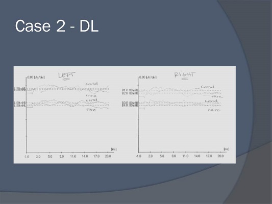 ABR tracings of right and left ear for case study DL