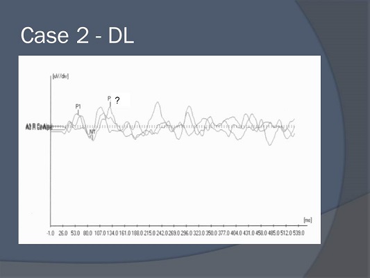 ALR tracings for case study DL
