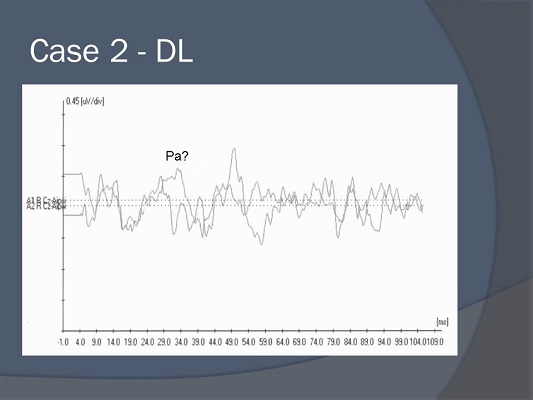 MLR tracings for case study DL
