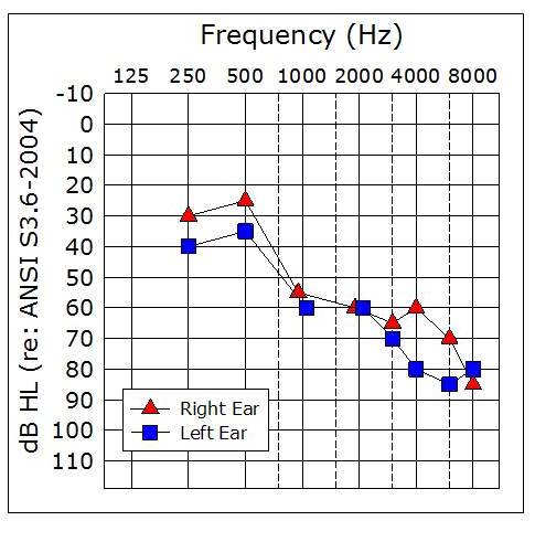 Sample patient&rsquo;s audiogram with word recognition scores of 68% in the right ear and 44% in the left ear