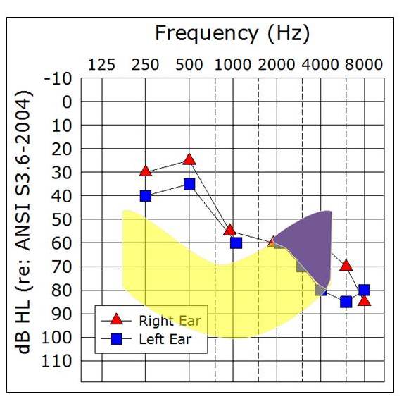 Sample audiogram with LTASS that roughly corresponds to a 100-105 dB HL presentation level
