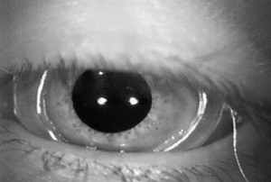 Scleral search coil
