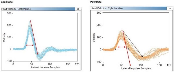 Tracings for head impulse maneuver comparing good data to poor data