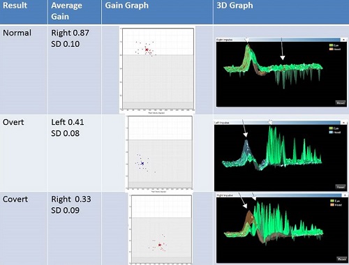 Gain graphs of normal tracings, overt saccades, and covert saccades