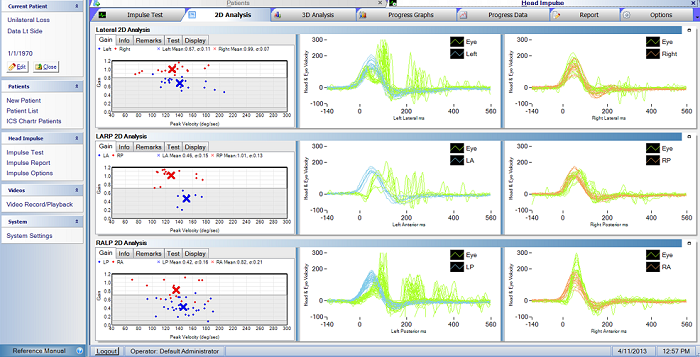 Left unilateral loss as recorded by the ICS Impulse