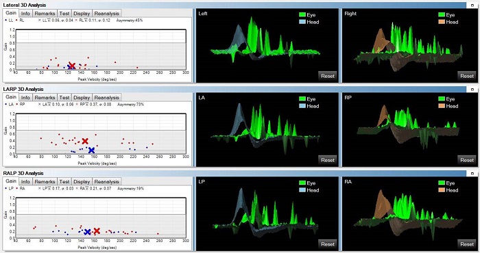 Bilateral vestibular loss as recorded by the ICS Impulse