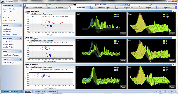 Left superior vestibular neuritis in gain, 2D and 3D analyses