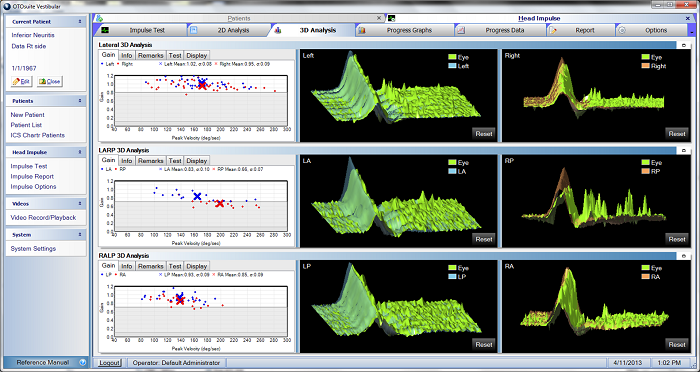 Right inferior vestibular neuritis in gain, 2D and 3D analyses