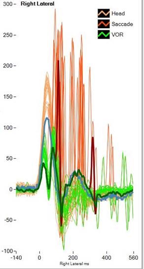 ICS Impulse vHIT recording data