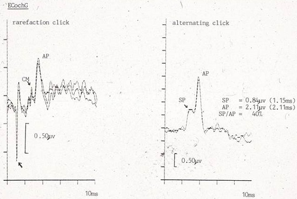 ECochG recording from a patient with Meniere&rsquo;s disease