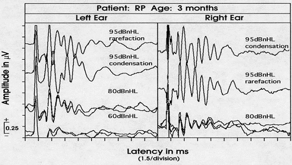 ABR recording from a 3-month old infant who failed a newborn hearing screening