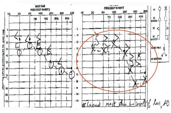 Audiogram from a 68-year-old female prior to ear impressions