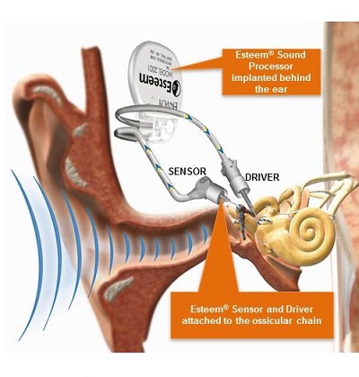 Components of the Esteem implant
