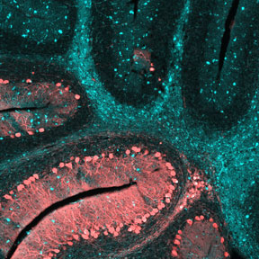 This image shows the cerebellum of a brain affected by NPC at the end stage of the disease