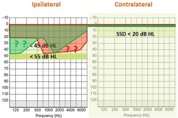 Fitting range comparisons of percutaneous, active transcutaneous and passive transcutaneous systems