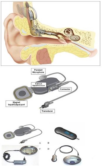 Carina middle-ear implant