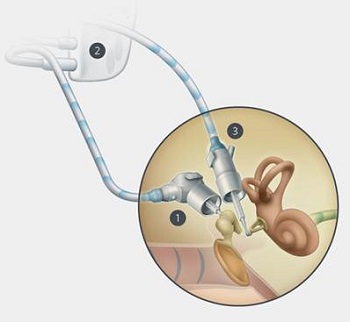 Envoy Esteem middle-ear implant