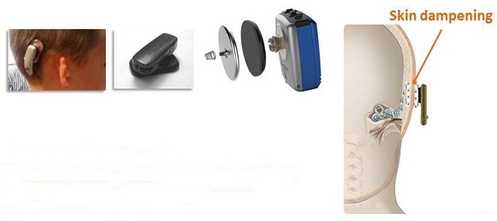 Passive transcutaneous skin-drive options