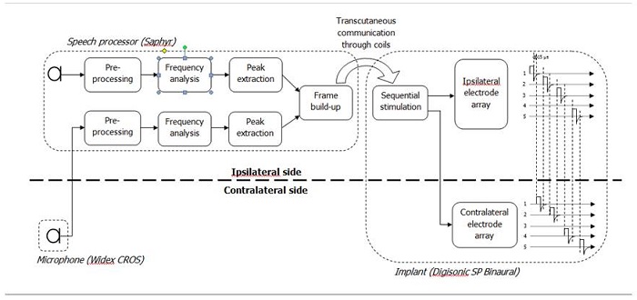 Binaural cochlear implantation
