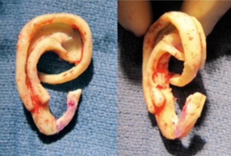 Final shape of the ear from the rib cartilage