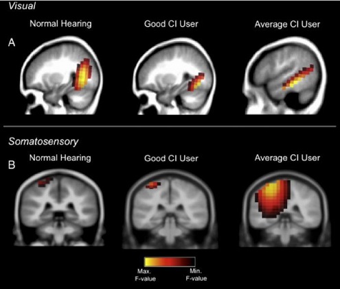 A good performer with the cochlear implant