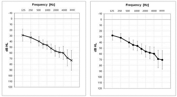 Mean audiogram for the right ear and left ear for the hearing impaired participants at Site 1