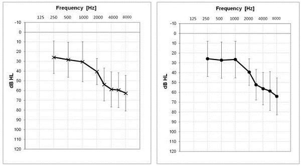 Mean audiogram for the right ear and left ear for the hearing impaired participants at Site 2
