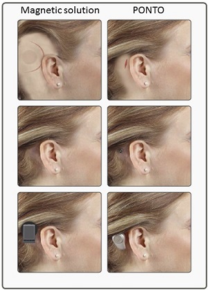 Cosmetic profile of a magnetic device and the Ponto