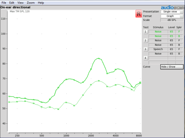 On-ear results of a RIC with a closed power dome