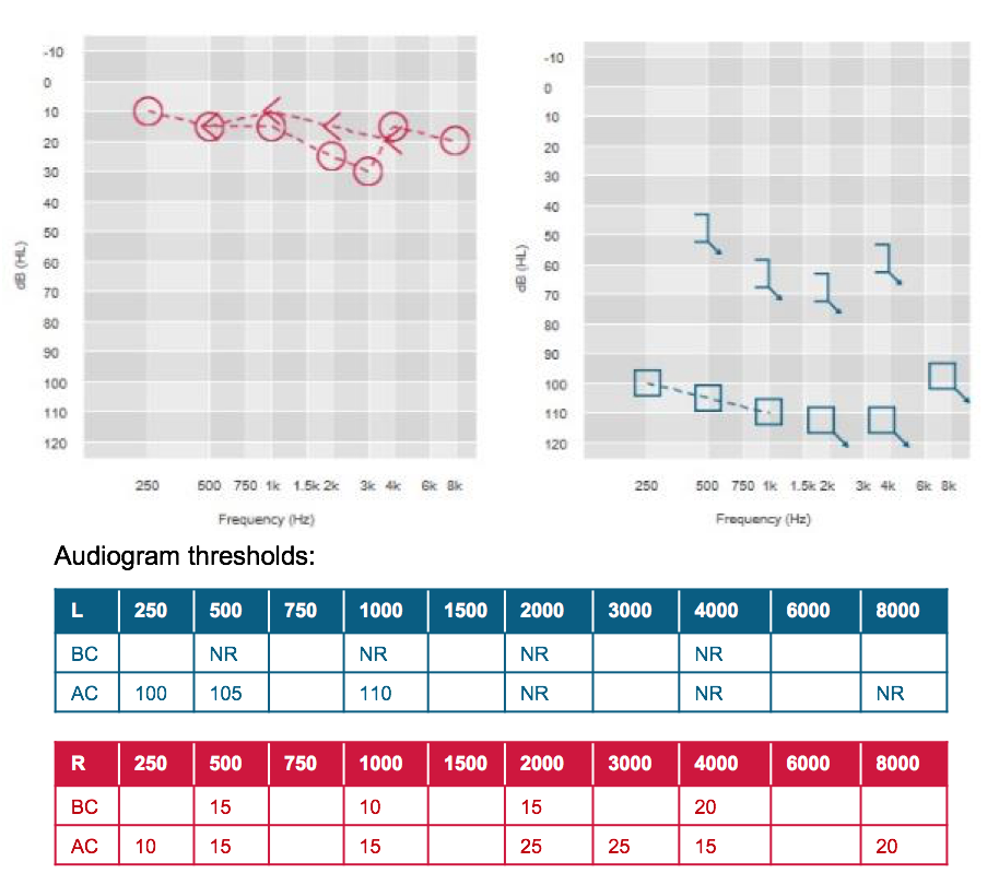 Steve's audiogram thresholds