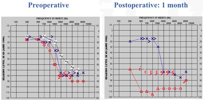 Residual hearing worst-case scenario